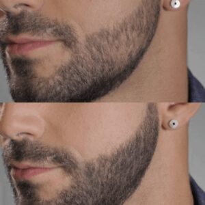 Micropigmentação de Barba